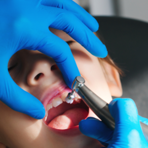 Fluoride Treatment | Dental Sealants in Yelahanka | Dental Sage