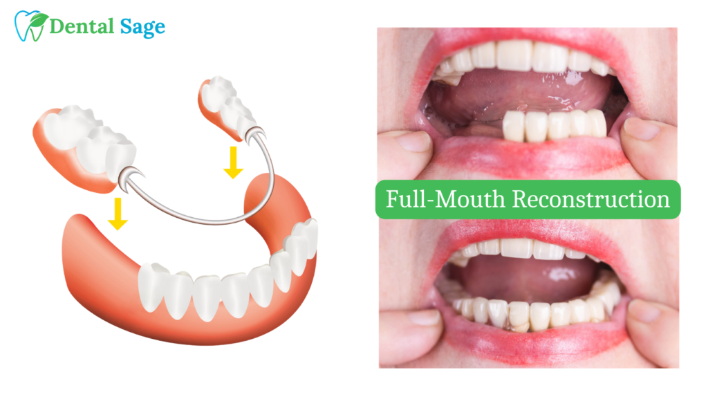 Full Mouth Rehabilitation in Yelahanka, Bangalore - Dental Sage